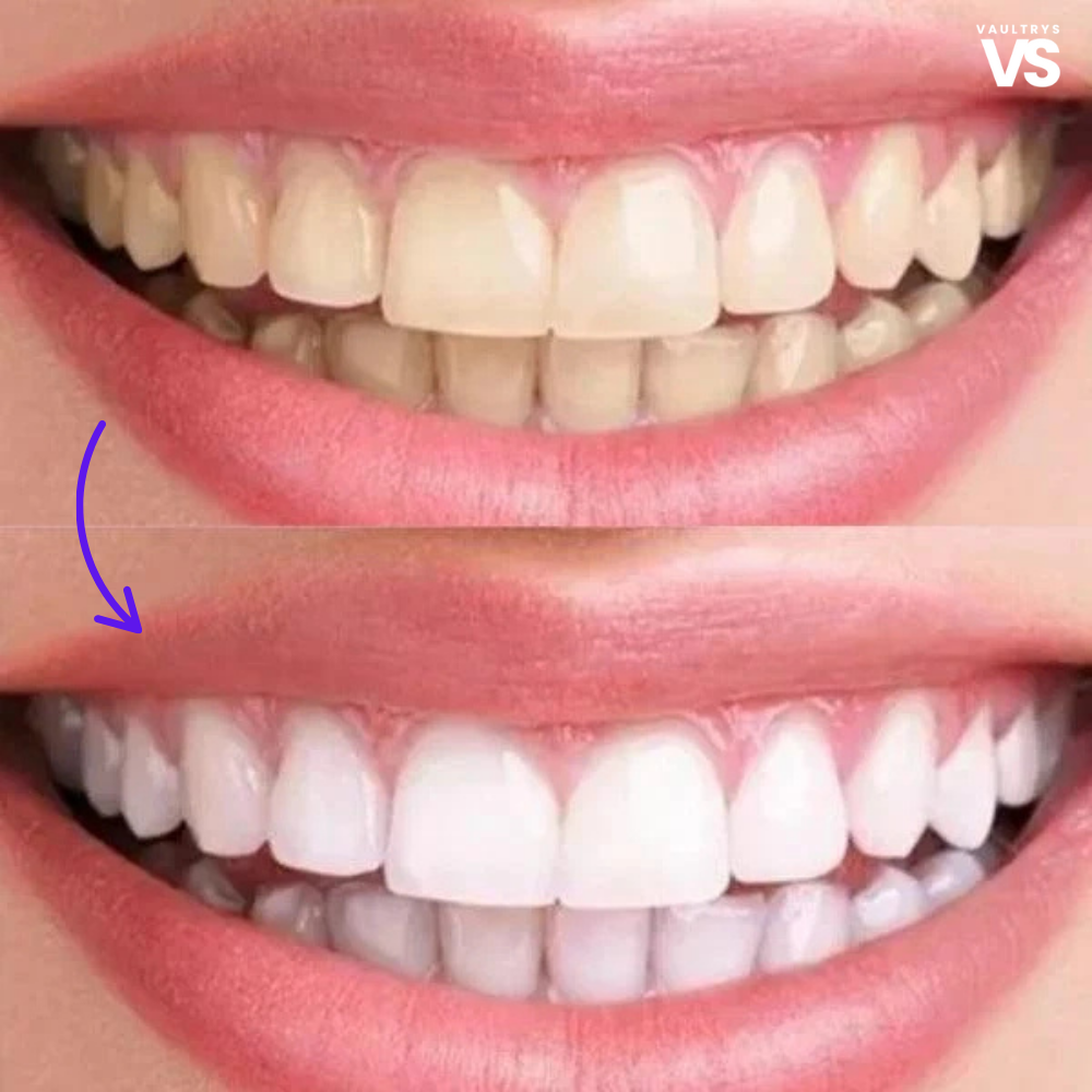 VAULTRYS® smile kit