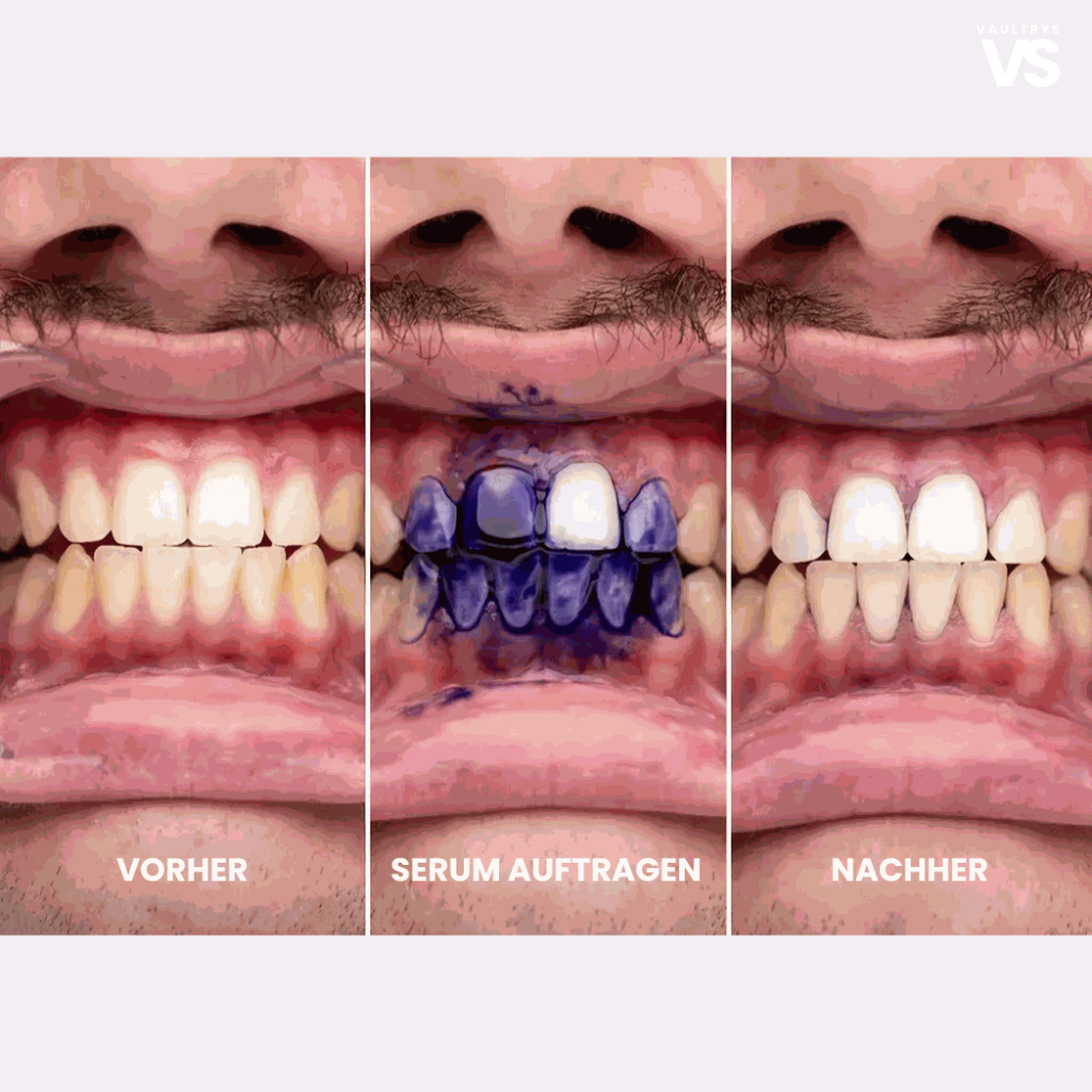 VAULTRYS® smile kit