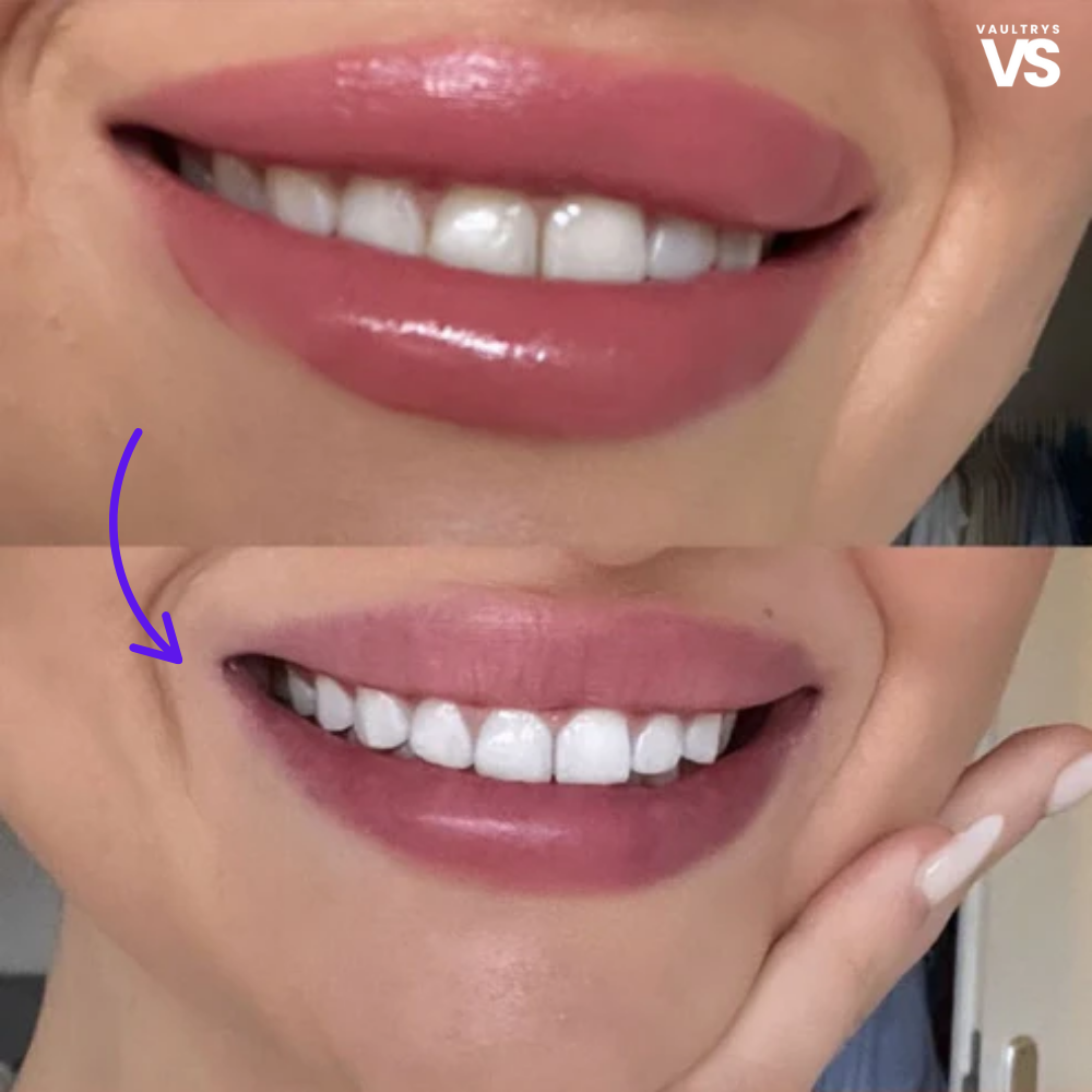 VAULTRYS® smile kit