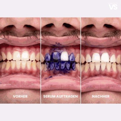 VAULTRYS® smilekit